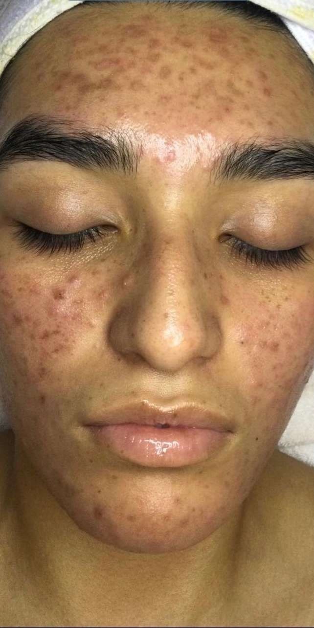 Client skin before treatment